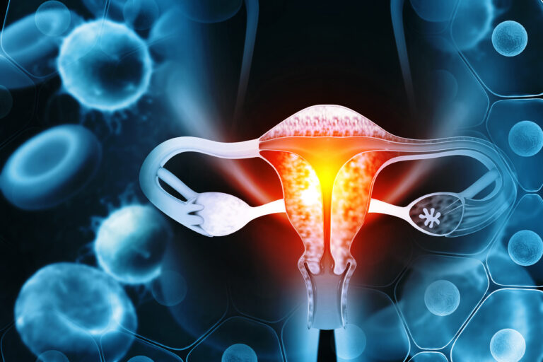 Endometrioza – co to jest i jakie są objawy?