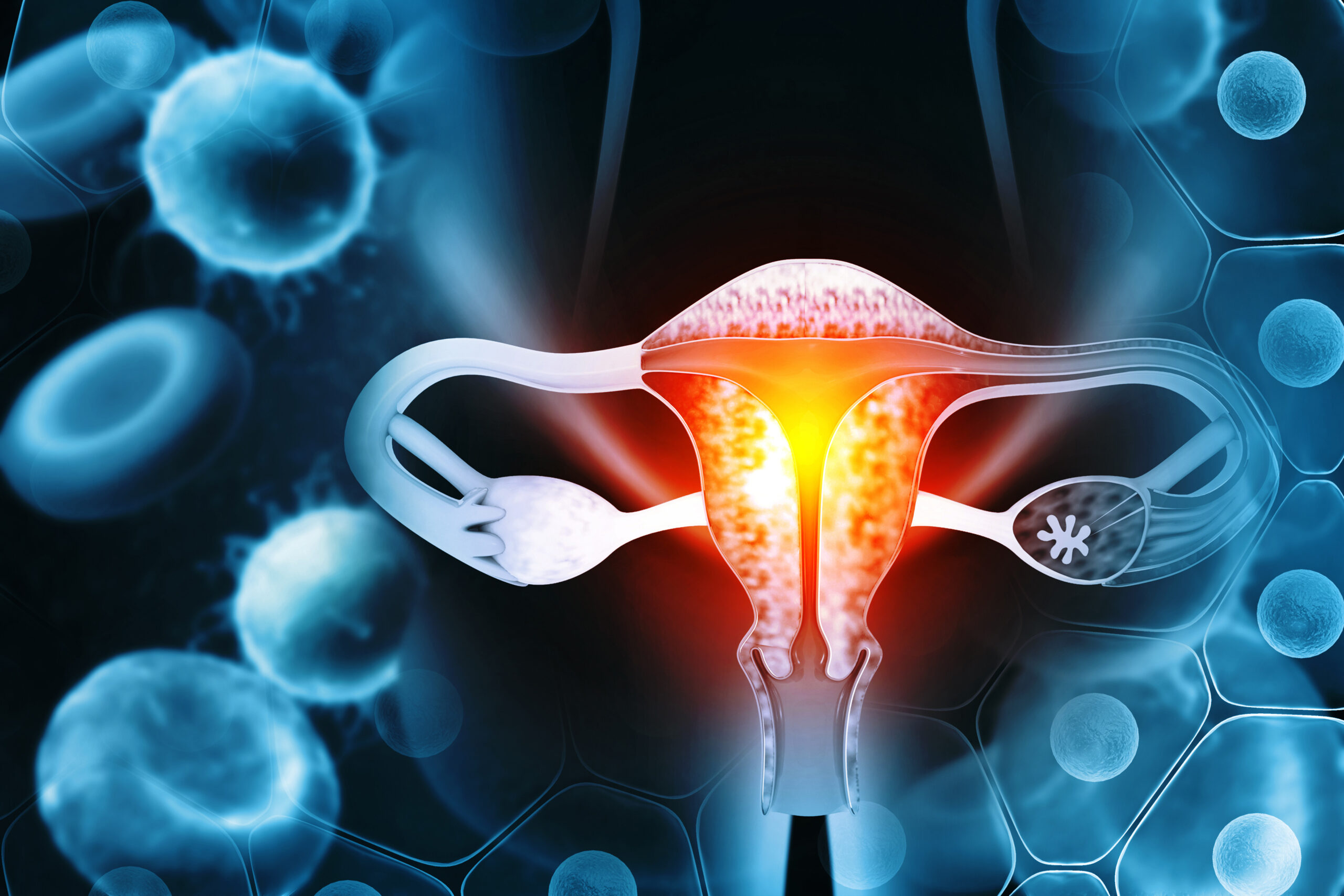 Endometrioza