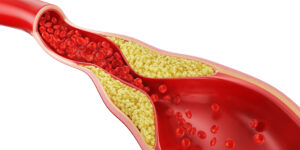 Hipercholesterolemia