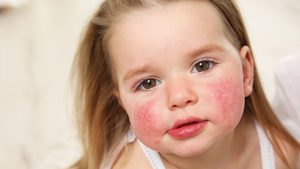 Pakiet badań - alergiczny pediatryczny (27 alergenów)